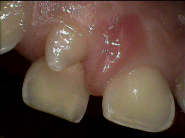 例3 過剰歯