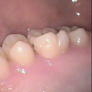 虫歯 初期 症状